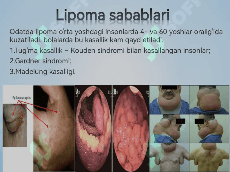 Ksantelazma. Lipoma. Gigroma 8