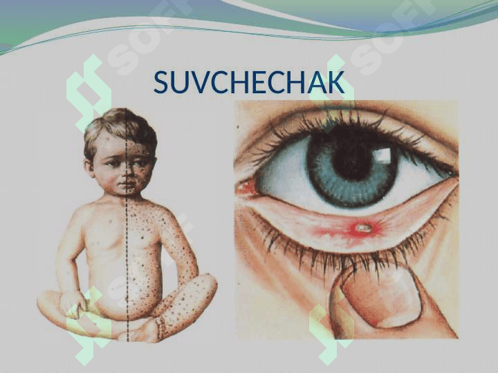 SUVCHECHAK, GERPETIK INFEKSIYALAR 8