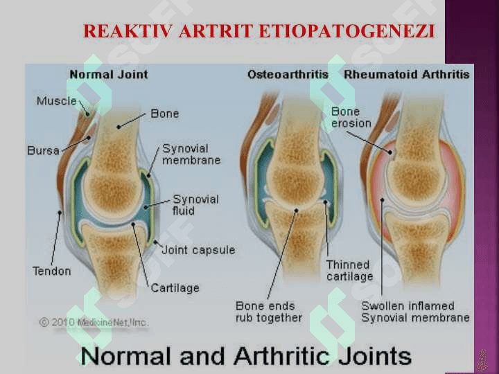 REAKTIV ARTRITLAR 3