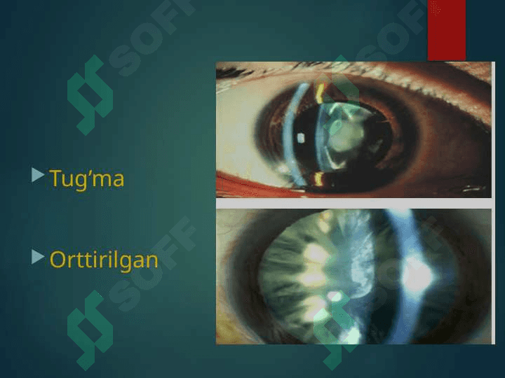 Kataraktani zamonaviy davolash usullari 5