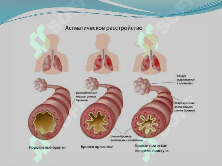Астматический статус. 8