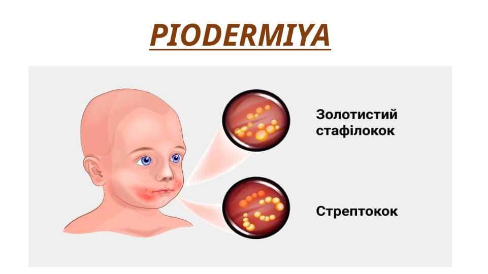 PIODERMIYA - ПИОДЕРМИЯ