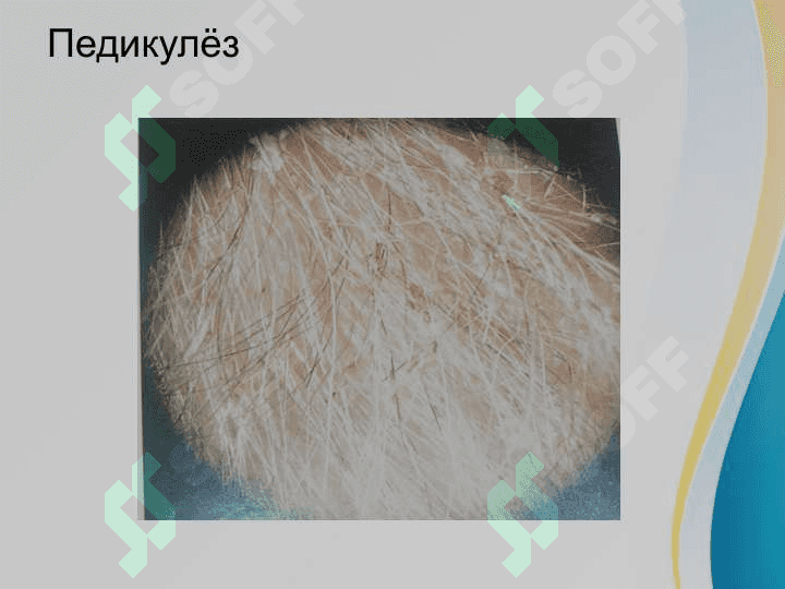 Bitlash Pedikulyoz . Битлаш педикулёз 4