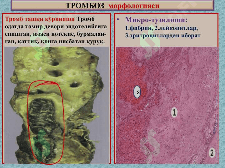 Тромбоз. Эмболия. Инфаркт 6