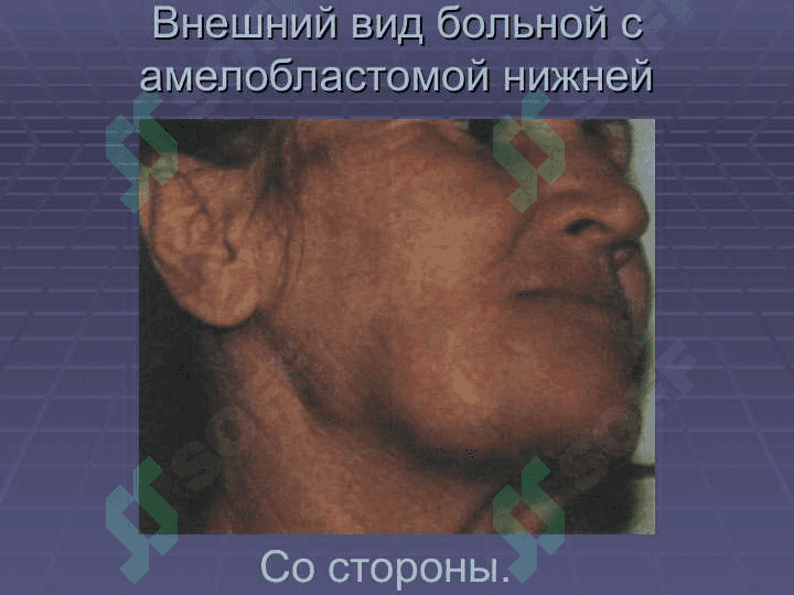 АМЕЛОБЛАСТОМА 4
