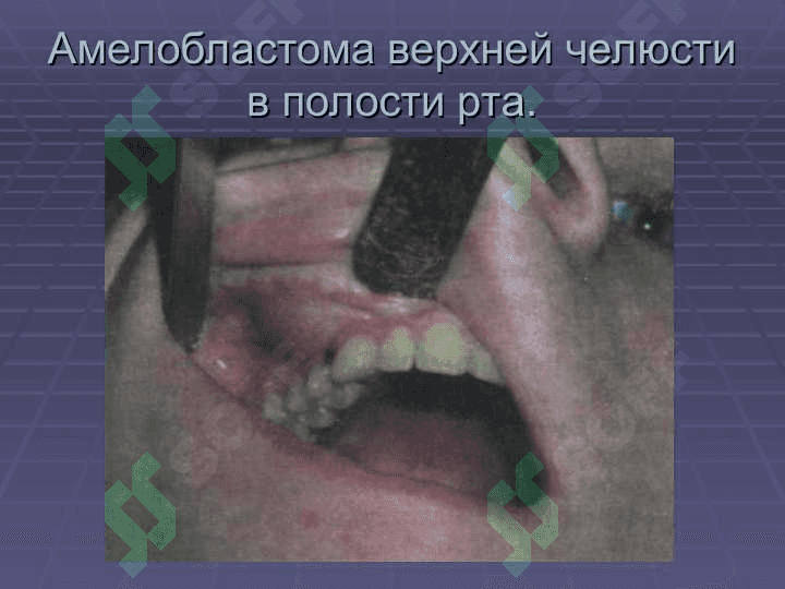 АМЕЛОБЛАСТОМА 6