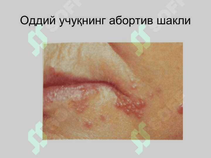 Терининг вирусли касалликлари 4