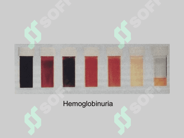 Hemolytic anemia 7