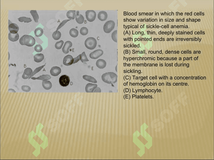 Anemia 4
