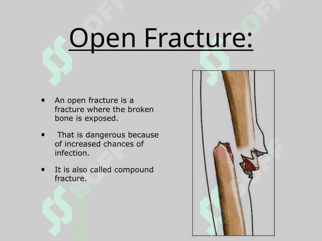Fractures 4