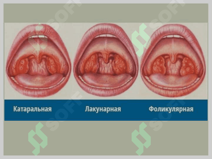 Ангины 4