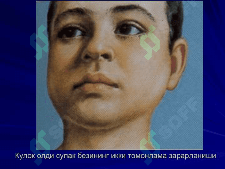 ЭПИДЕМИК ПАРОТИТ 8