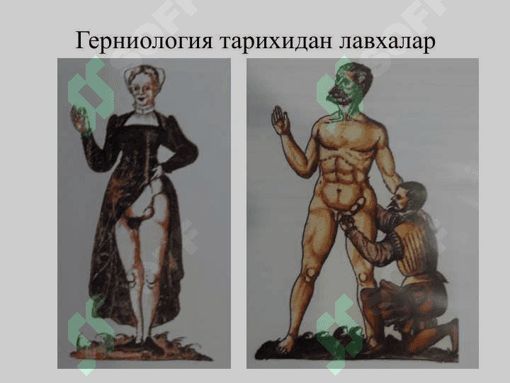 Mavzu:Қорин чурралари ва унинг асоратлари 4