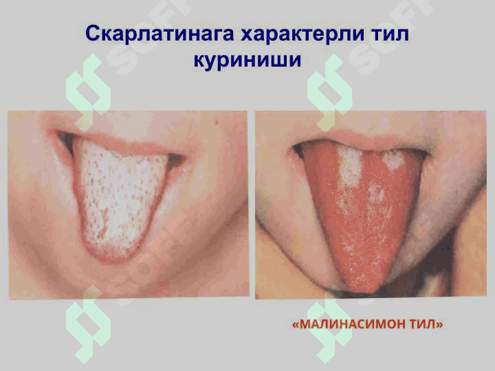 СКАРЛАТИНА 3