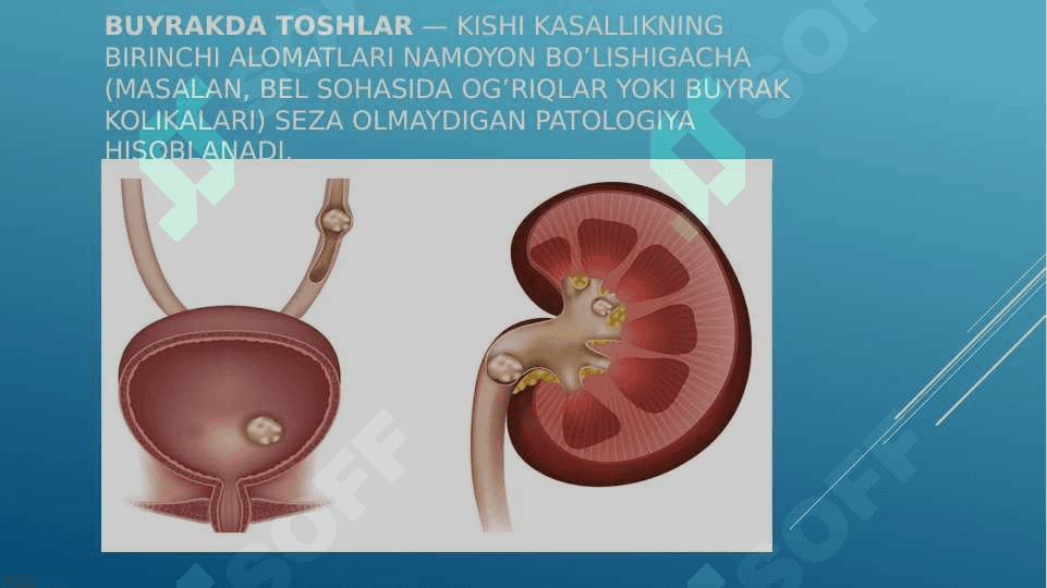 BUYRAKLARDA URAT TOSHLARINING HOSIL BO’LISHI VA DAVOLASH YO’LLARI 2