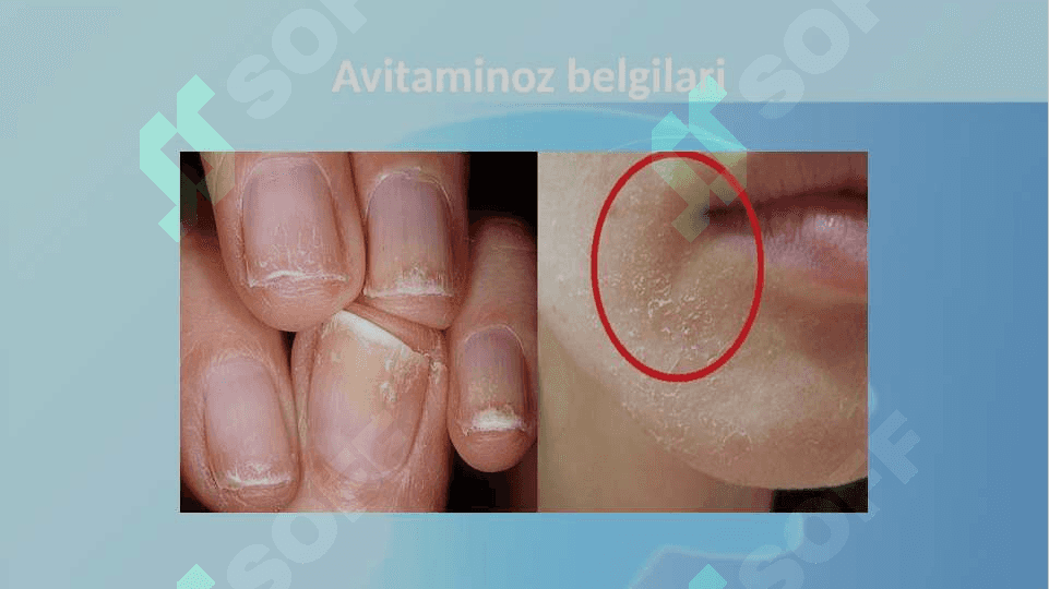 Avitaminoz (gipovitaminoz) 8
