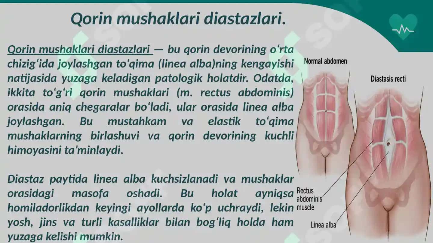 Qorin mushaklari  diastazlari 3