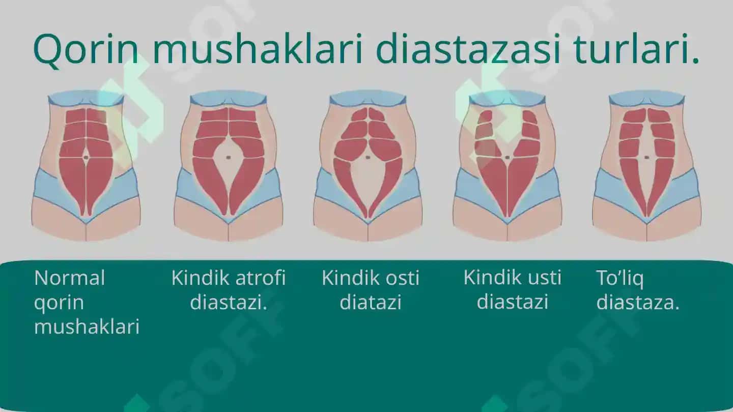 Qorin mushaklari  diastazlari 4