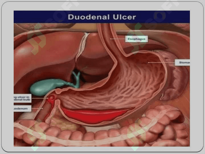 DUODENAL SHIRA 4