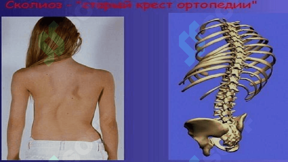 Сколиоз 3