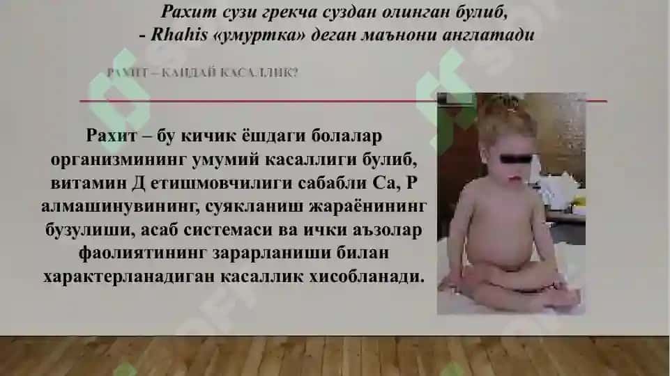 Bolalarda raxit kasalligi 3
