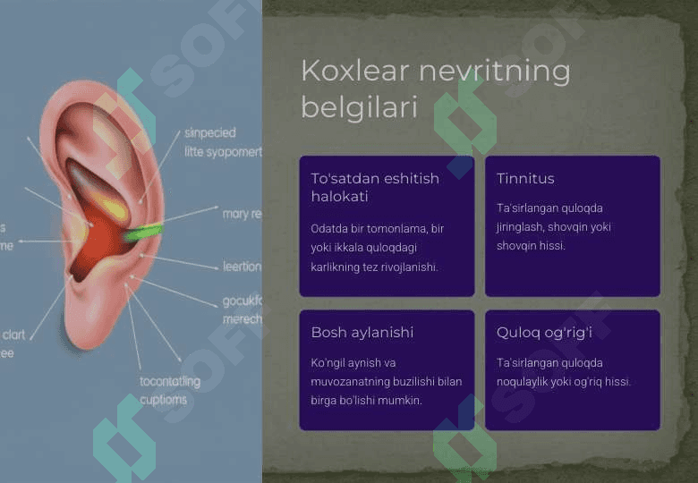 Koxlear nevrit 8