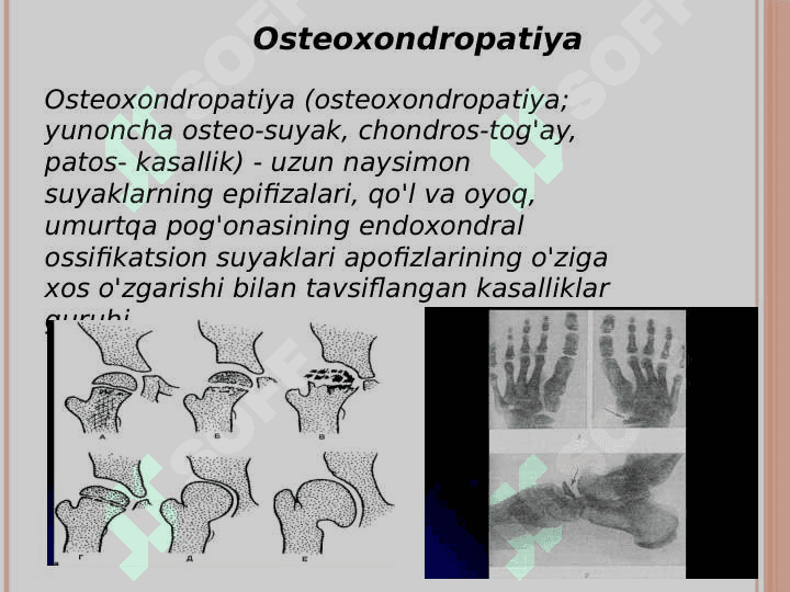Ostioxondropatiyalar. 3