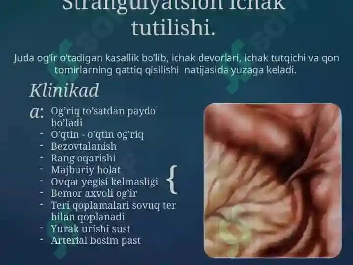Orttirilgan o’tkir ichak tutilishi 4