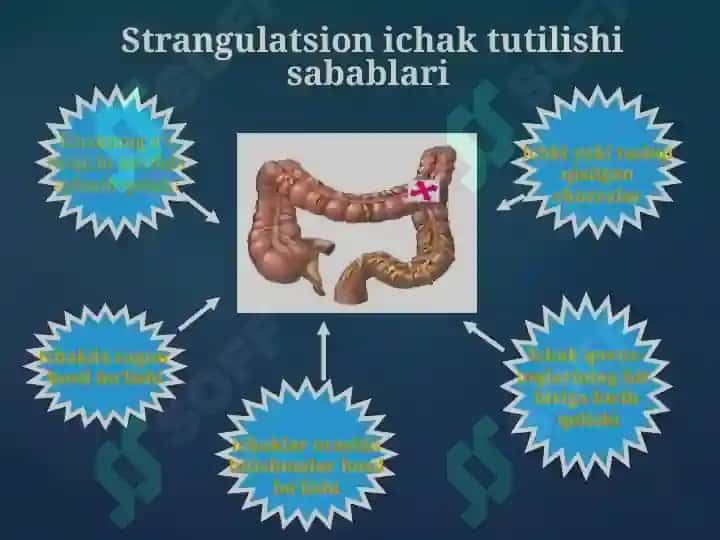 Orttirilgan o’tkir ichak tutilishi 5