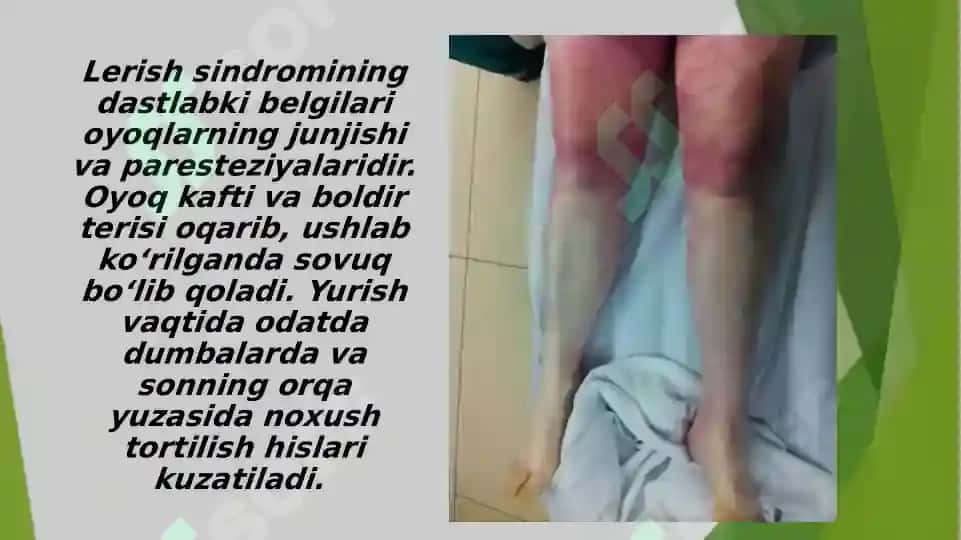 Lerish sindromi 8