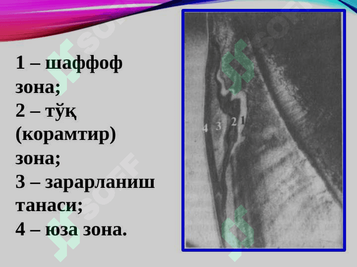 Karies va ovqatlanish
tamoyillari 4