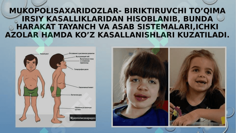 Mukopolisaxaridozlar 2