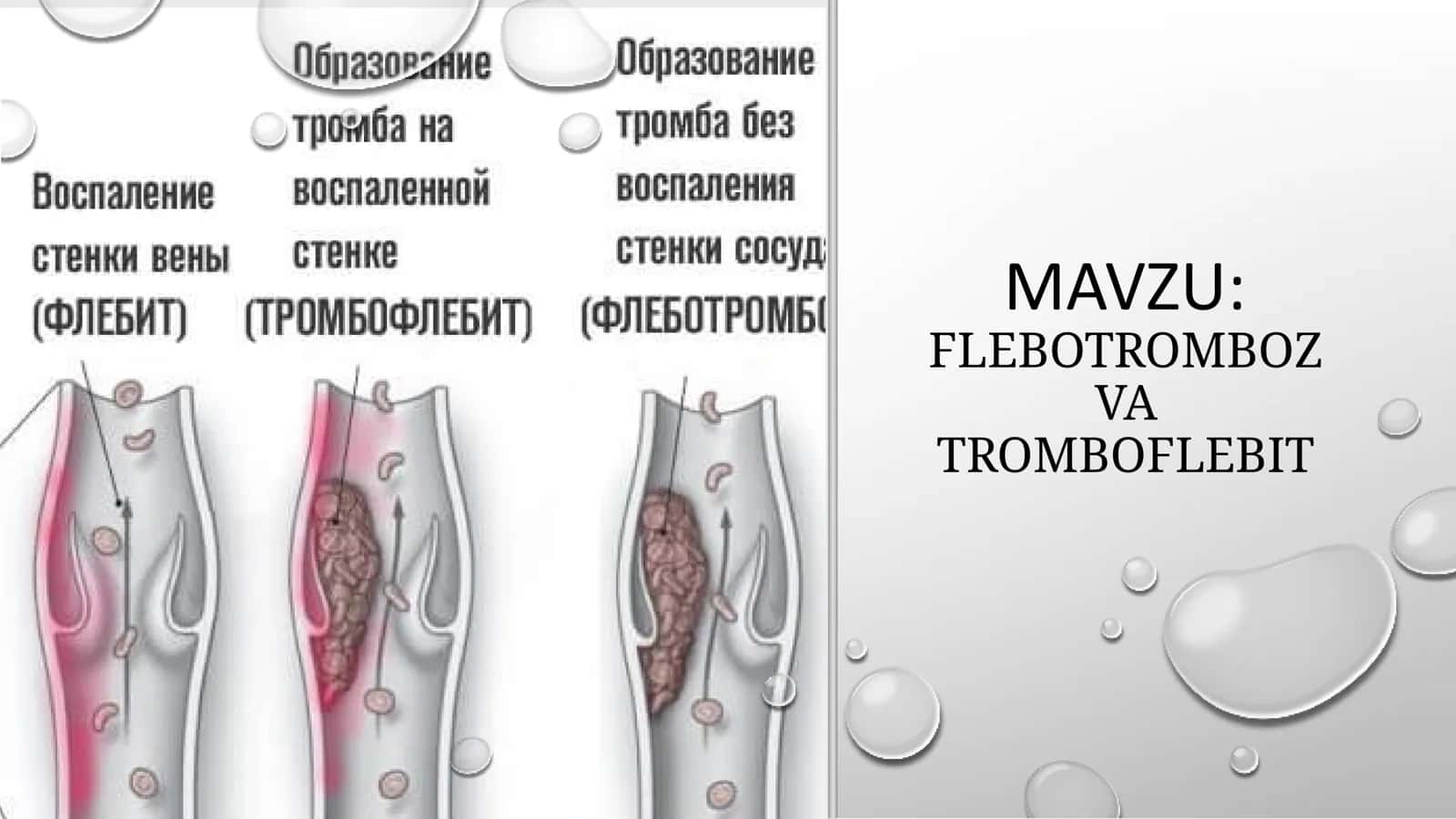 FLEBOTROMBOZ VA TROMBOFLEBIT 1