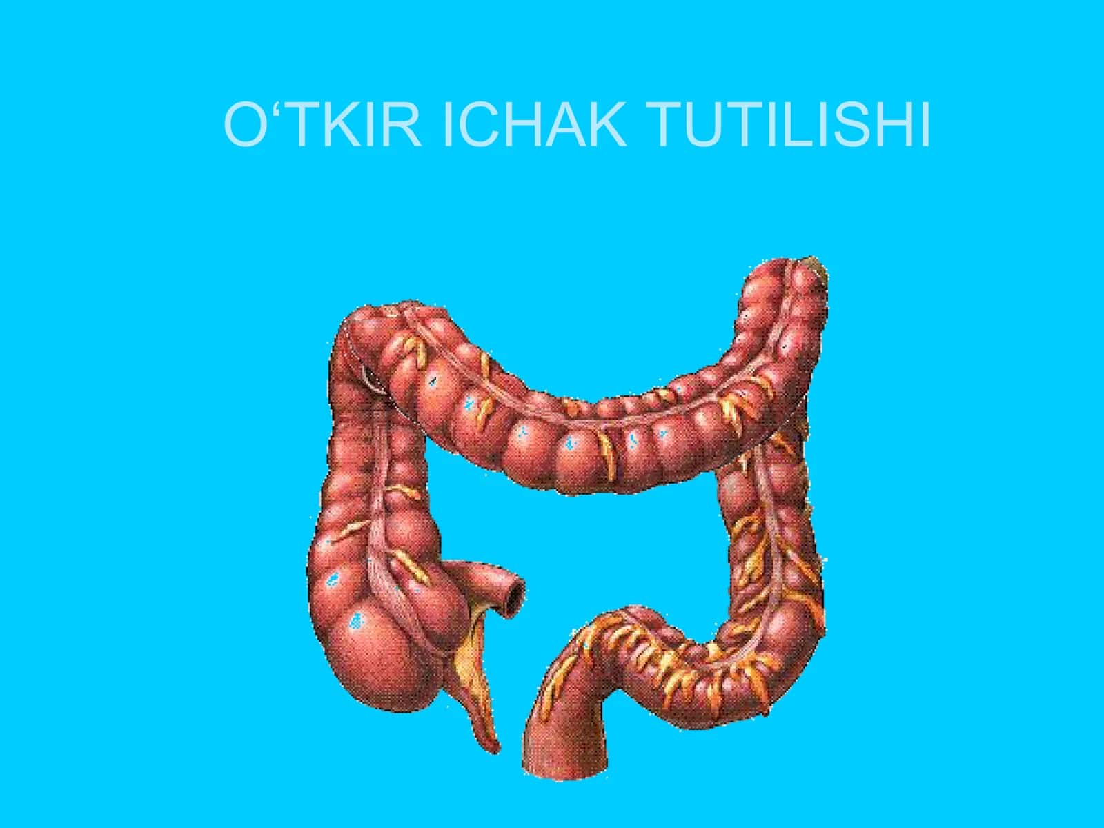 O‘TKIR ICHAK TUTILISHI 1