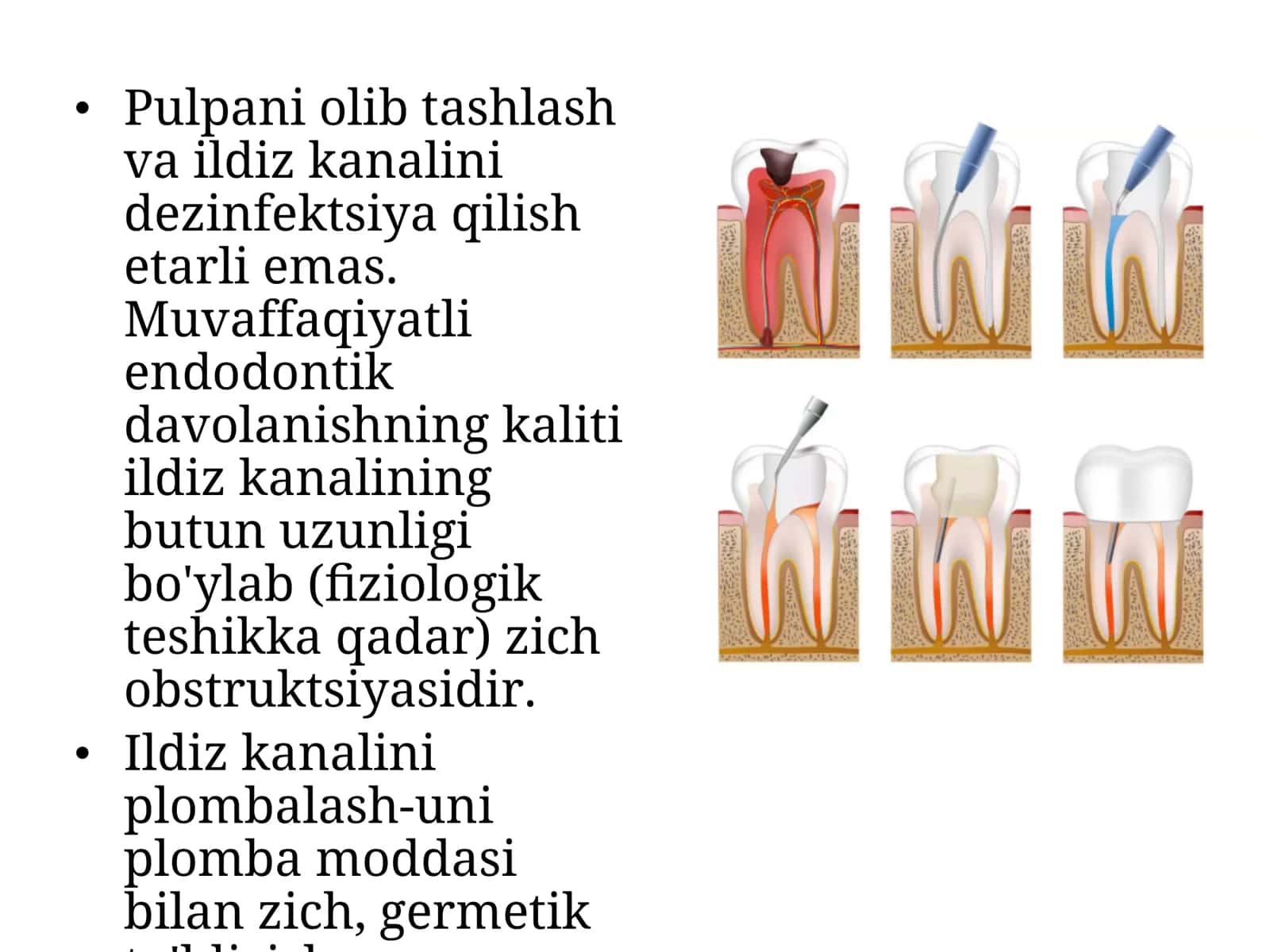 Ildiz kanalini plombalash 2