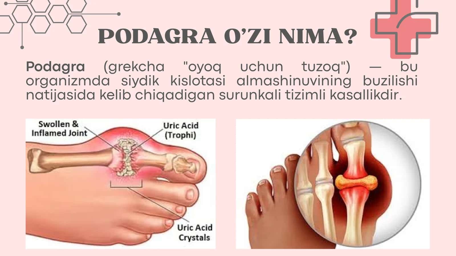Podagra 2