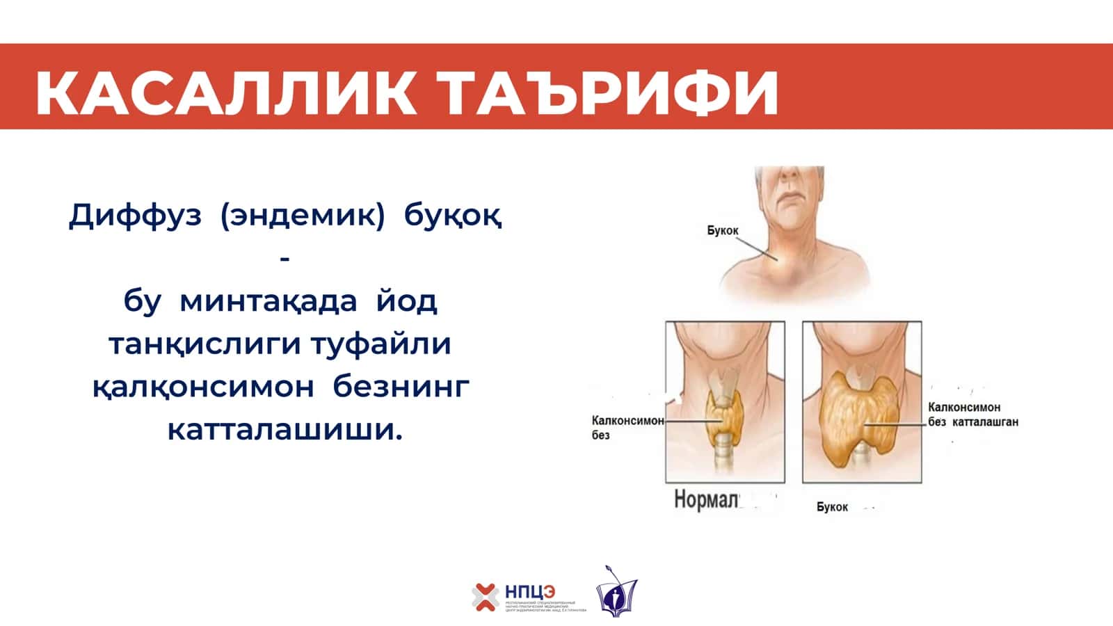 Yod tanqisligi buqoq 2