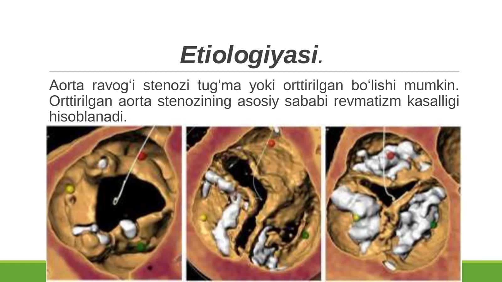 Aorta ravogi stenozi 3