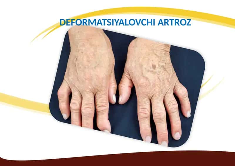 Deformatsiyalovchi Artroz 1