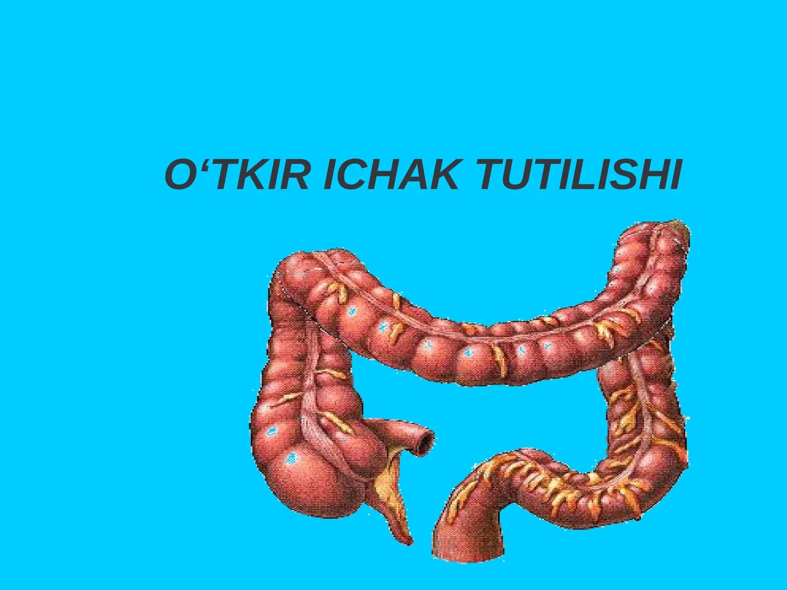 O‘TKIR ICHAK TUTILISHI 1