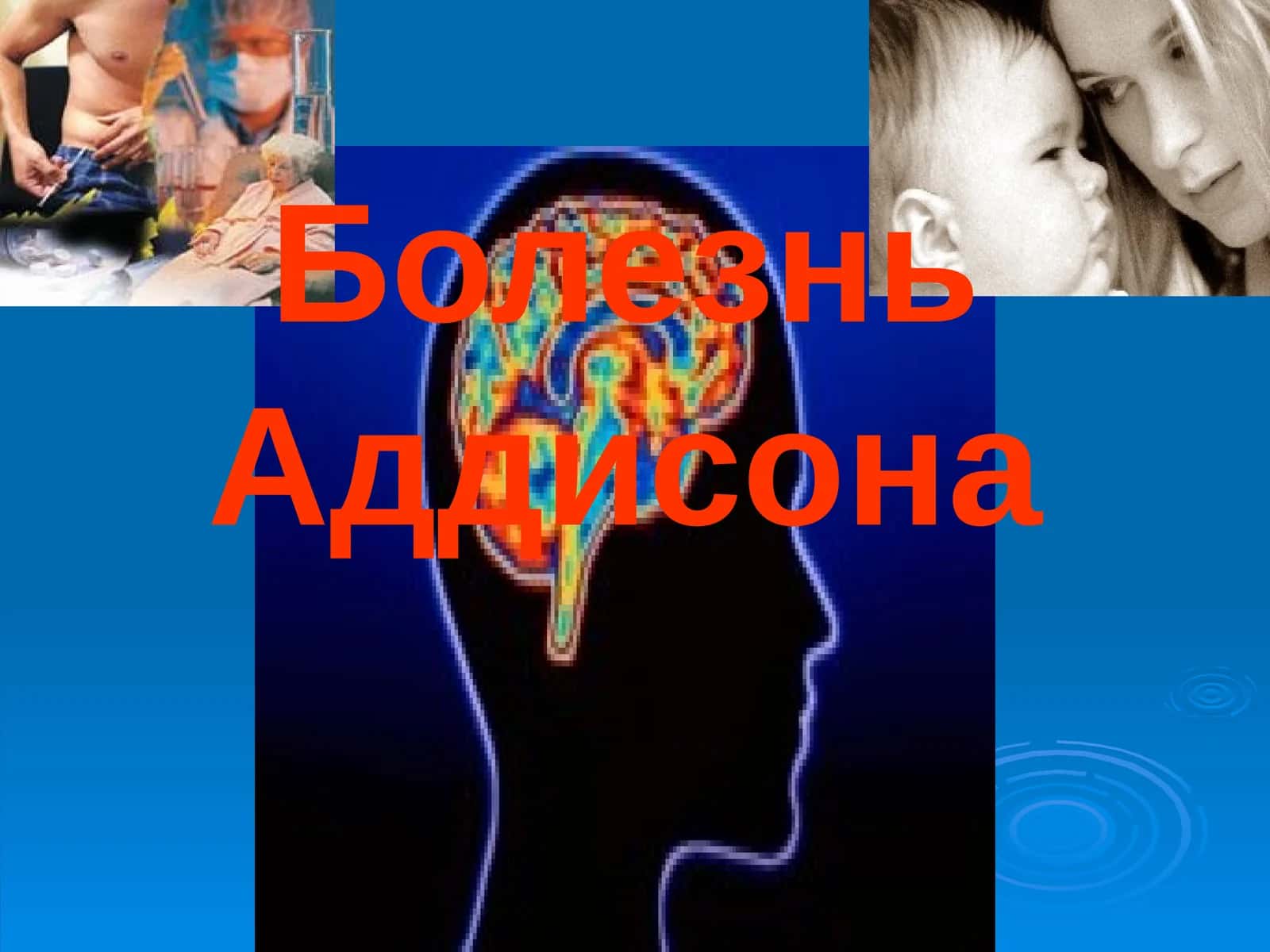 Болезнь Аддисона 1