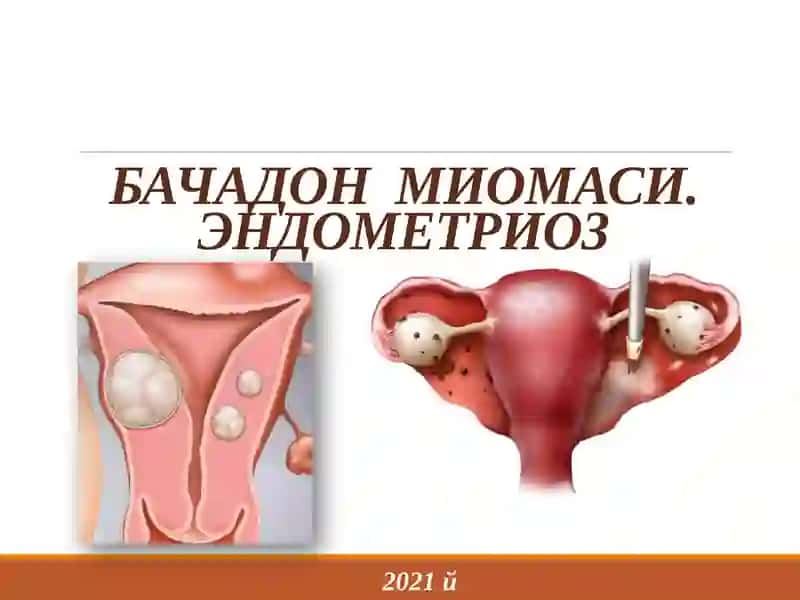 Bachadon  miomasi. endometrioz