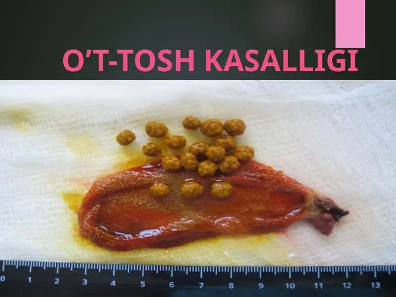 O'T-TOSH KASALLIGI 1