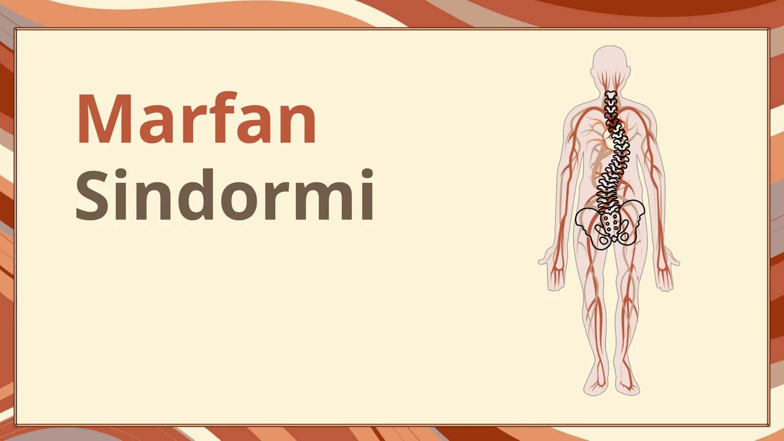 Marfan Sindromi 1