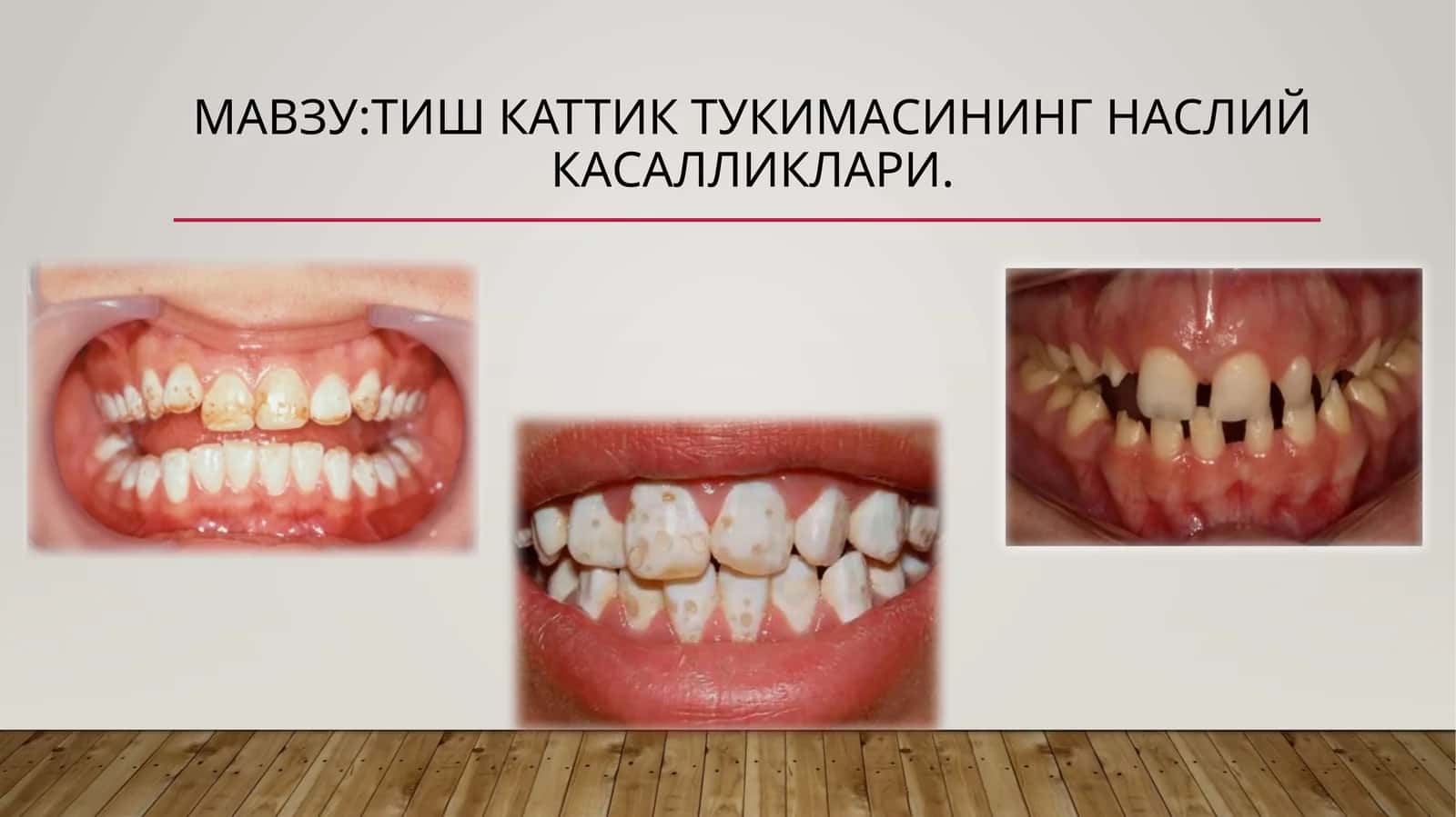 Тиш каттик тукимасининг наслий касалликлари 1