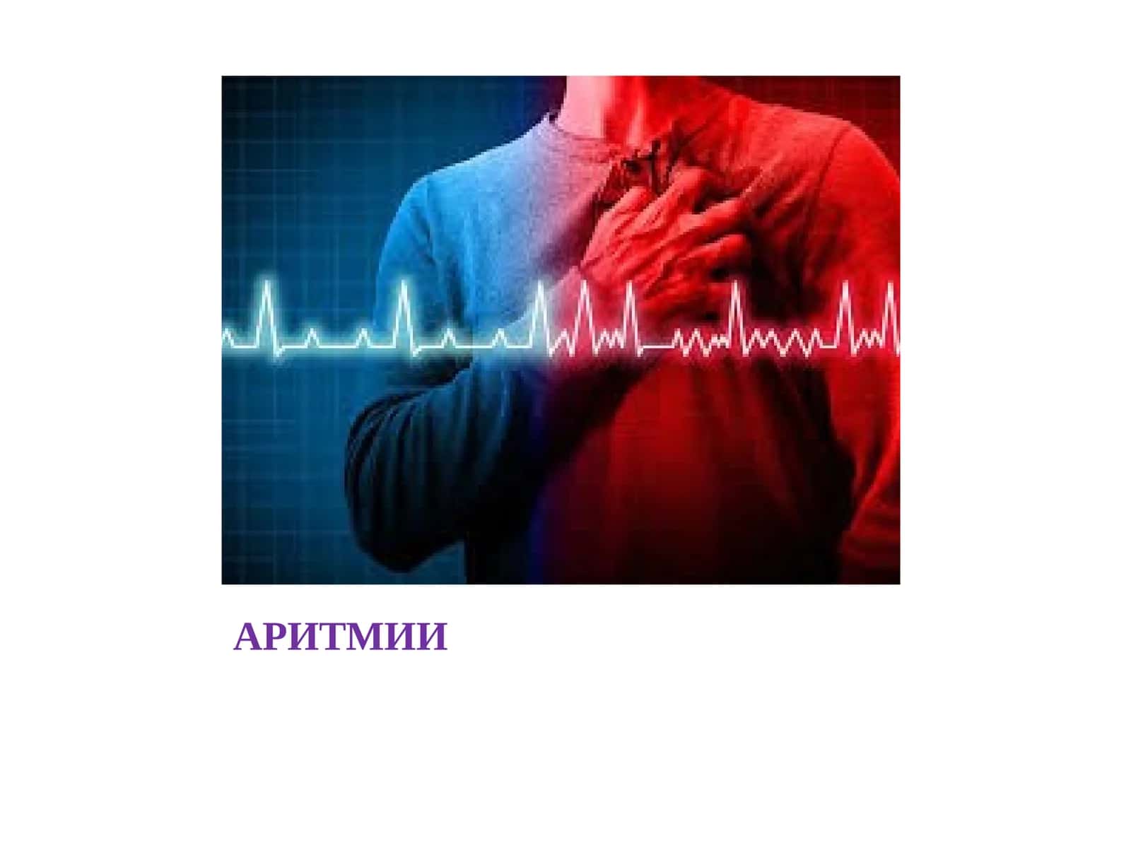 АРИТМИИ 1