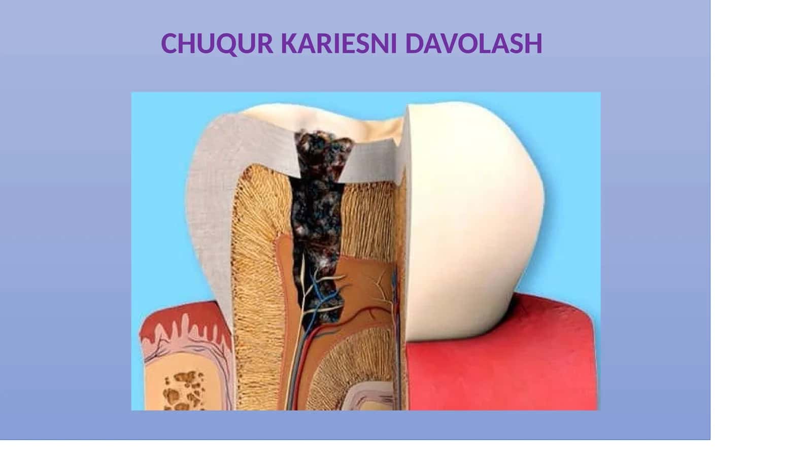 CHUQUR KARIESNI DAVOLASH 1