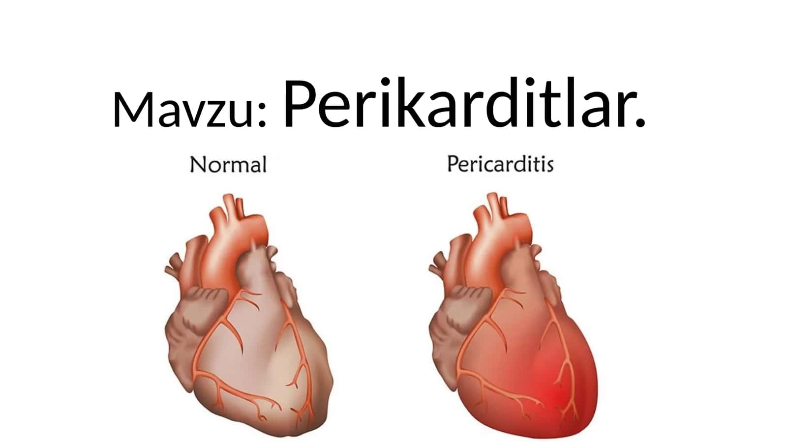 Perikarditlar 1