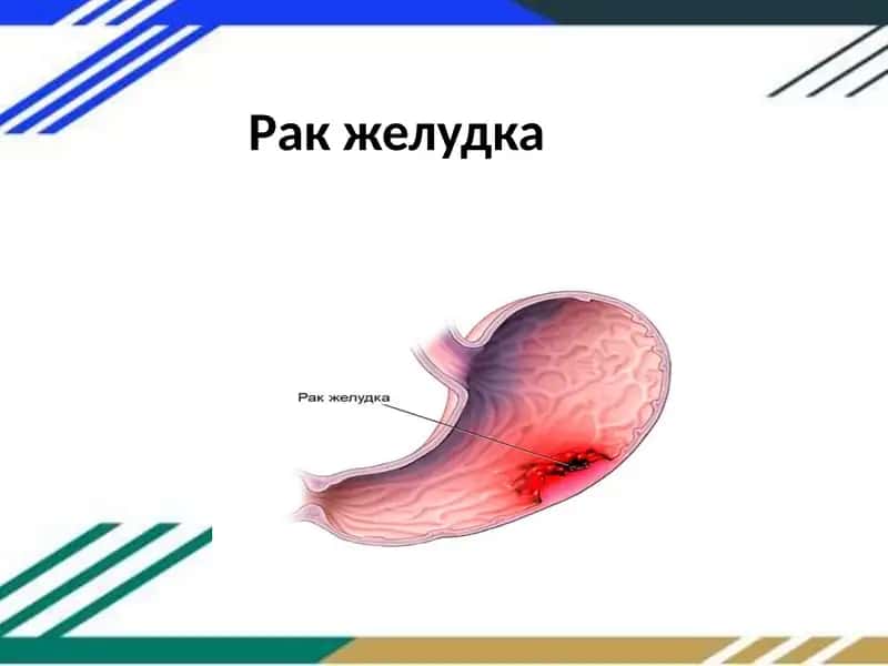 Рак желудка 1