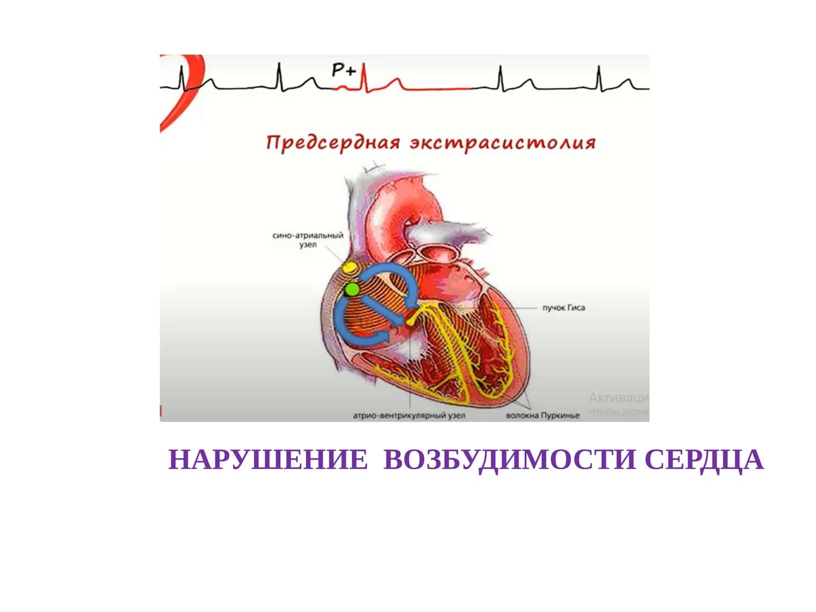 НАРУШЕНИЕ  ВОЗБУДИМОСТИ СЕРДЦА 1